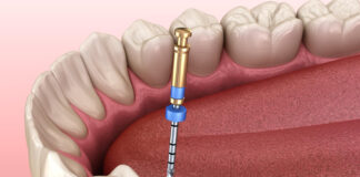 Vađenje živca – Kada je neophodna ova procedura? Vadjenje zivca