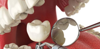 Delimična bezubost – Problem koji je rešiv! Delimična bezubost