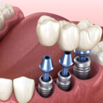 ugradnja-zubnih-implantata-trendy-2