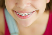 Proteze za decu – Za pravilan zubni niz mališana! Proteze za decu