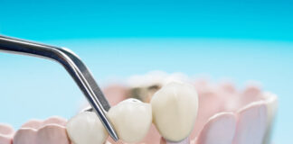 Šta je zubni most? Zubni most
