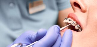 Fiksne proteze – Sve što treba da znate o njima Fiksne proteze