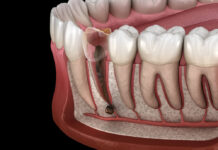 Kako prepoznati mrtav zub? Mrtav zub